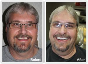 Male patient from Charleston Dental Associates before and after dental veneers