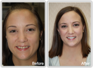 Female patient from Charleston Dental Associates before and after dental veneers