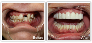 Patient mouth before and after veneers from Charleston Dental Associates